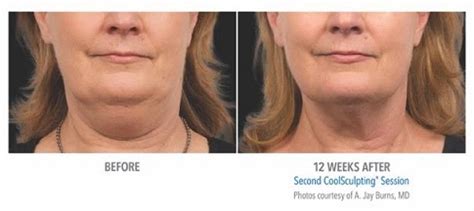 Coolsculpting Double Chin Toronto | Clarity MedSpa