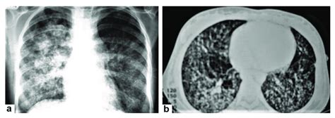 Miliary TB in an 18-year-old man (same patient of Figure 1). (a) Chest... | Download Scientific ...