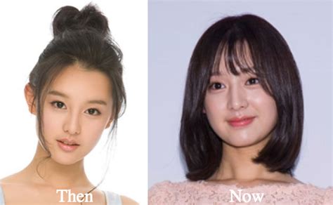 Kim Ji Won Plastic Surgery Before and After Photos