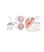 Myocardial Fibrosis