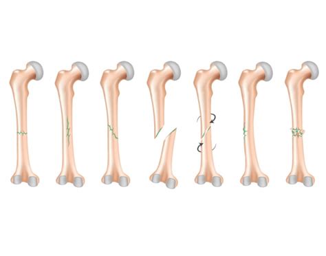 Common Types of Bone Fractures — Printable Worksheet