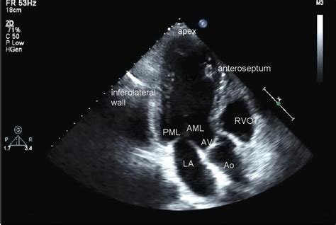 TTE: Transthoracic Echocardiogram - SONOSIF - by SIFSOF, California