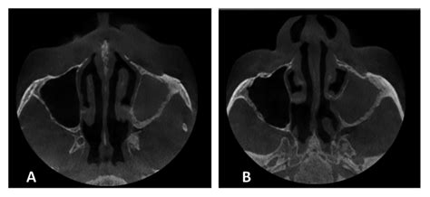 | A) Left maxillary sinus opacification associated with bone remodeling ...