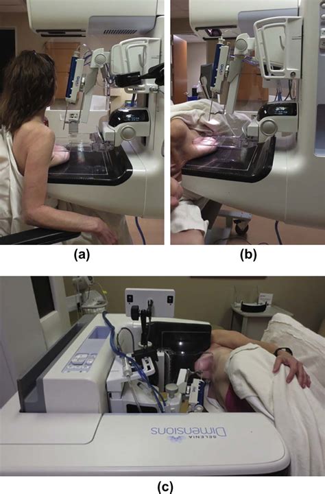 Implementation of Upright Digital Breast Tomosynthesis-guided Stereotactic Biopsy - Academic ...