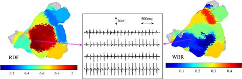 Frontiers | Regional Dominant Frequency: A New Tool for Wave Break Identification During Atrial ...