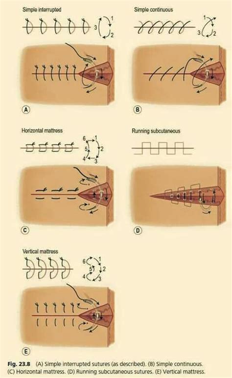 Suture | Surgical nursing, Medical school studying, Vet medicine