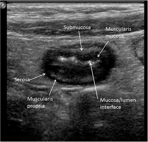 Paediatric bowel ultrasound in inflammatory bowel disease - European Journal of Radiology