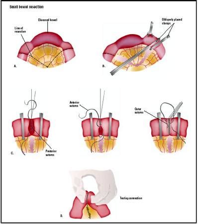 Small Bowel Resection - procedure, recovery, blood, tube, removal, pain, complications, time (2022)