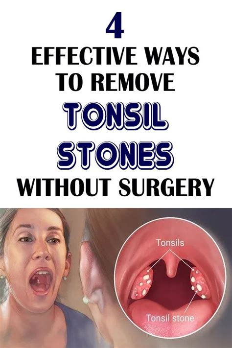 How To Remove Tonsil Stones Back Of Throat - HOWTORMEOV