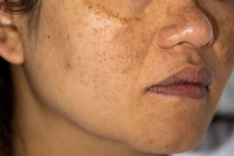 Simple Home Remedies For Hyperpigmentation