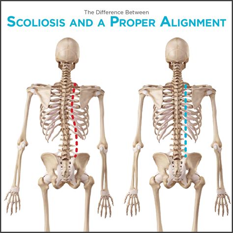 Scoliosis Types: Congenital, Neuromuscular, Degenerative or Idiopathic