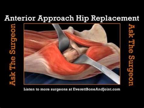 Anterior Approach for Total Hip Replacement - YouTube