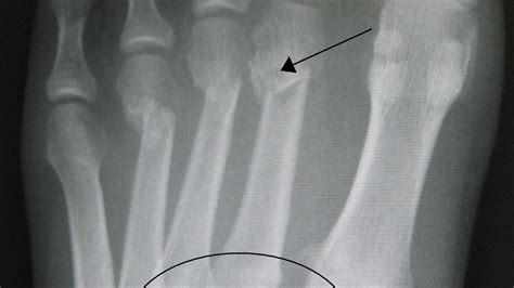 Lisfranc X Ray