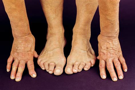 Are Bunions and Arthritis Related? | Kansas Foot Center