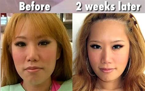 Meet Xiaxue, A Chinese Singaporean's Plastic Surgery Story