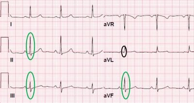 Heart Attack: Heart Attack Ekg