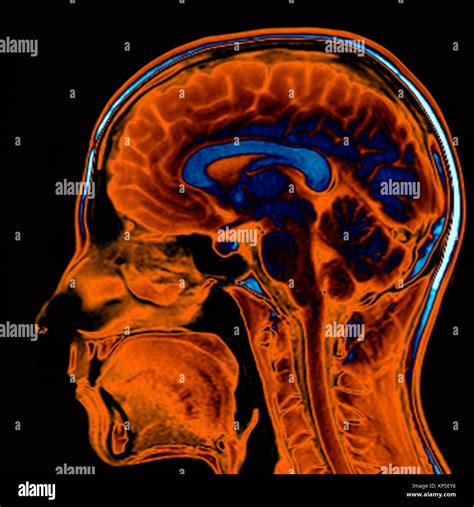 Coloured Magnetic Resonance Imaging Mri Scan Of A Sag - vrogue.co