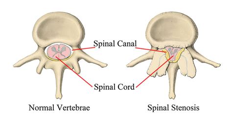 Lumbar Stenosis