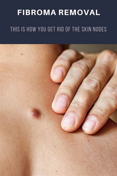 Fibroma Removal: This is How You Get Rid of The Skin Nodes | How to ...