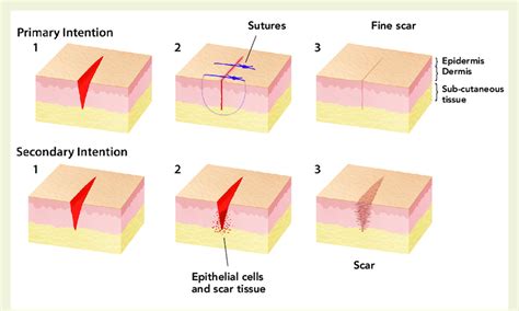 Difference in wound healing between primary and secondary intention closure | Download ...