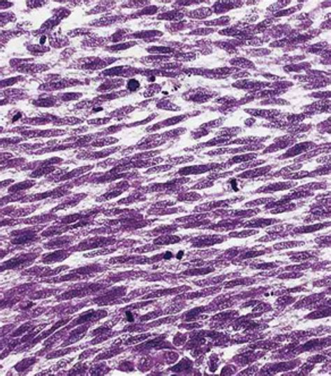 Soft Tissue Sarcoma - Pathology - Orthobullets