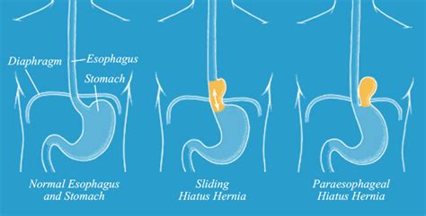 Types Of Hiatal Hernia Surgery