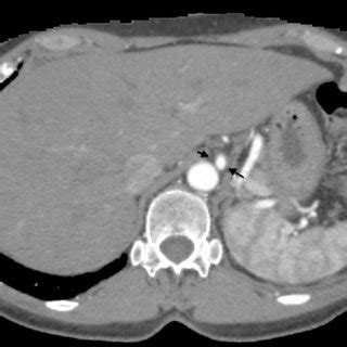 Celiac trunk angiography shows stenosis and a small pseudoaneurysm of... | Download Scientific ...