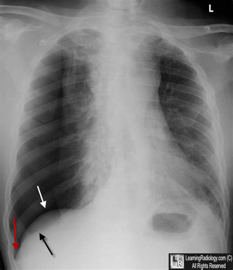 Learning Radiology - deep sulcus sign, pneumothorax