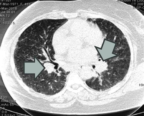 CT scan of chest showing bilateral hilar lymphadenopathy & prominent... | Download Scientific ...