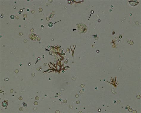 Urine crystals | eClinpath