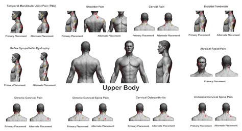 tens unit placement for biceps tendonitis ...