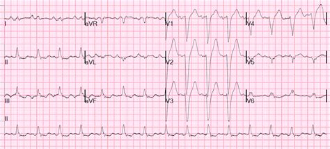 Dr. Smith's ECG Blog: Left Bundle Branch Block, Severe Chest pain, Previous Normal Angio. What ...