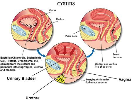 Cystitis: Symptoms, Causes and Treatments - A Comprehensive Guide ...