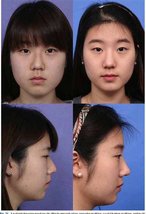 Figure 21 from Rhinoplasty in the Asian nose. | Semantic Scholar