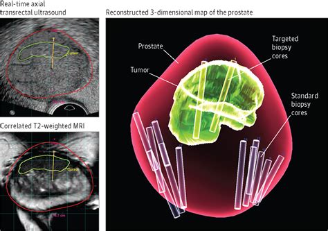 Detecting Prostate Cancer With MRI and Biomarkers | Cancer Biomarkers ...