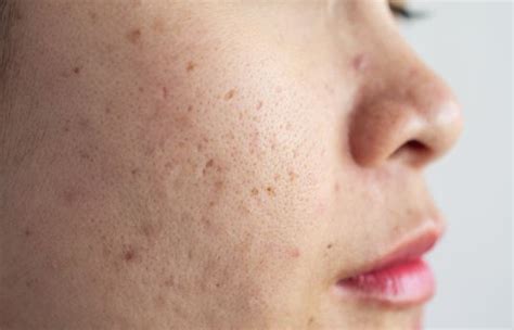 Ask a Dermatologist: How to Get Rid of Pitted Acne Scars