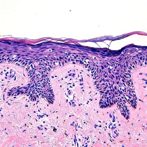 speckled lentiginous nevus on the inferior part of the leg after... | Download Scientific Diagram