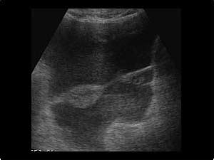 Abdomen and retroperitoneum | 1.4 Spleen : Case 1.4.7 Trauma of the ...