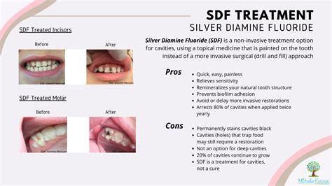 Silver Diamine Fluoride (SDF) | Arlington, Virginia | Michelle Keaney Flanagan, DMD