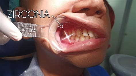 Undergoing Zirconia Dental Crown Procedure after Root Canal Treatment ...