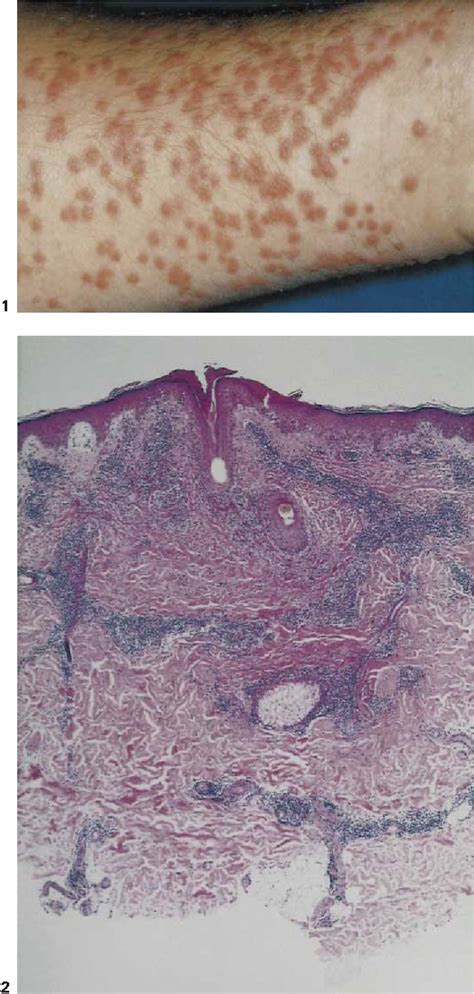 Figure 1 from Aquarium Dermatitis: Cercarial Dermatitis in an Aquarist | Semantic Scholar