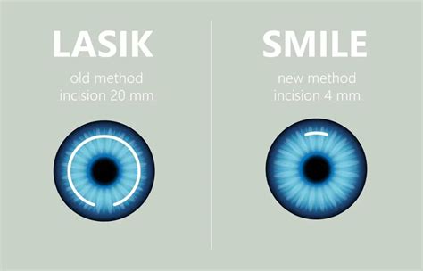 Is Smile Eye Surgery Safe? | Discover Vision