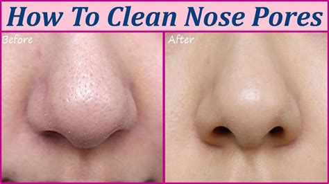 How To Clean Out Nose Pores At Home - Grizzbye