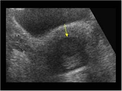 Gynaecology | 3.1 Uterus : Case 3.1.2 Miscellaneous benign uterine and ...