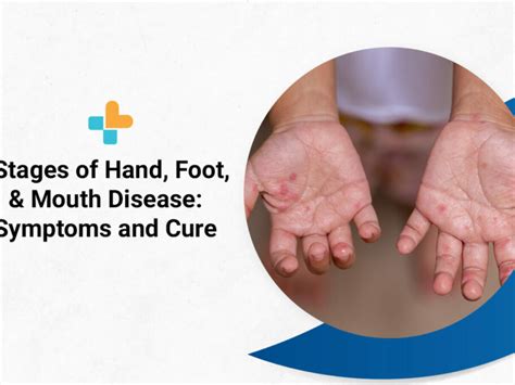 Hand Foot And Mouth Disease In Adults