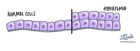 Hyperplasia | MyPathologyReport.ca