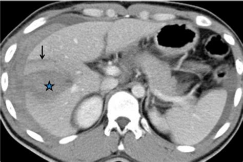 c: CT scan demonstrating a shattered spleen in a 21-year-old male ...