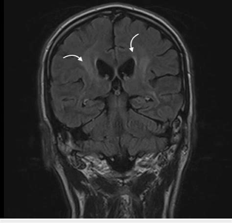 MRI demonstrating abnormal non-specific T2 hyperintense and mild FLAIR... | Download Scientific ...