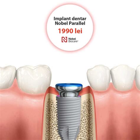 Implant Dentar - Implant Dentar Pret - Clinicile DentoCare