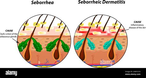 Causes Seborrhea skin and hair. Dandruff seborrheic dermatitis. Eczema. Dysfunction of the ...